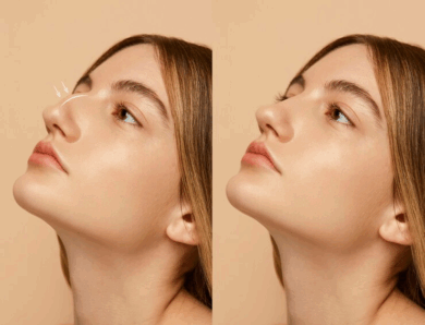 Rhinoplastie à Lyon : peut-on corriger une cicatrice ancienne liée à une blessure nasale ?
